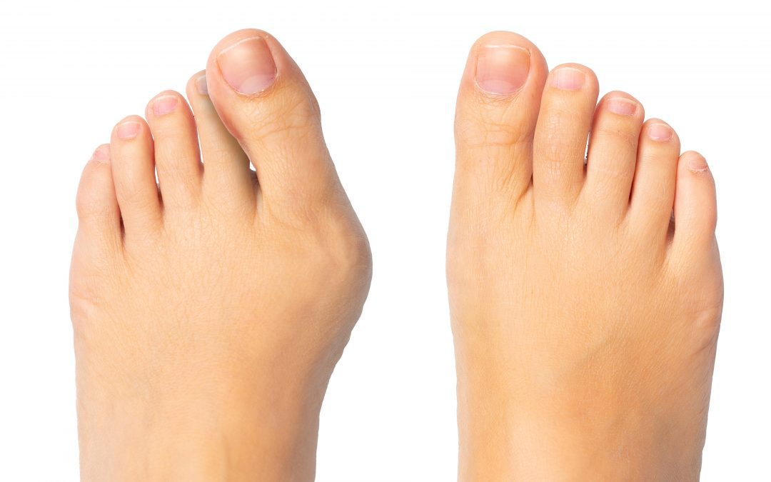 cause of bunions