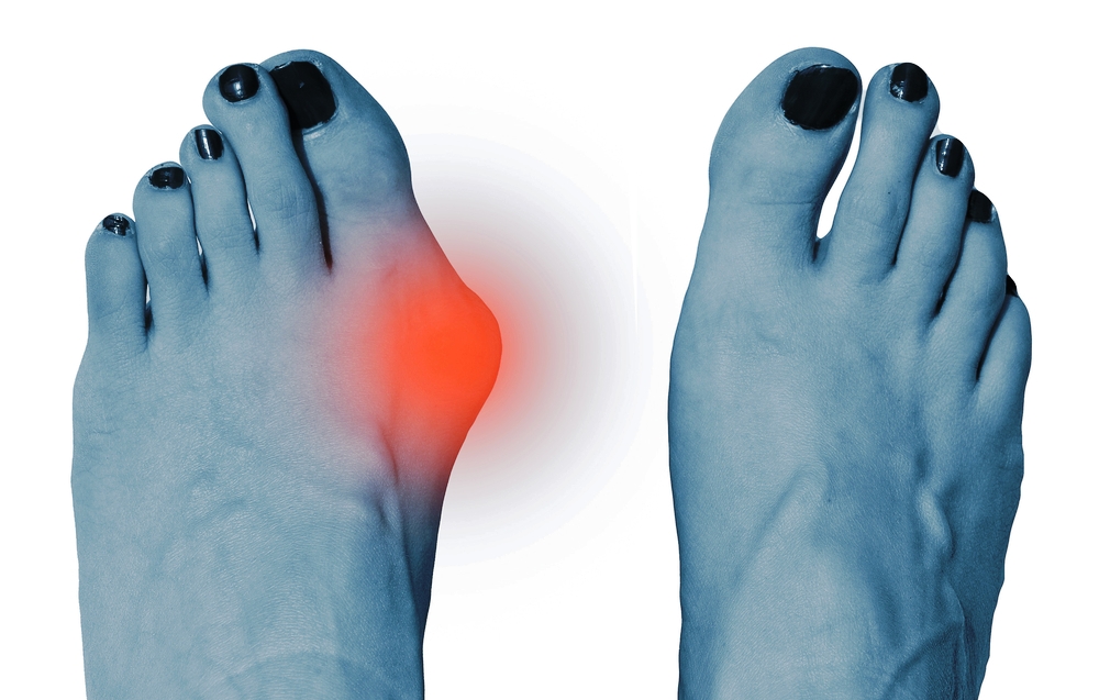 difference between hallux valgus and bunions